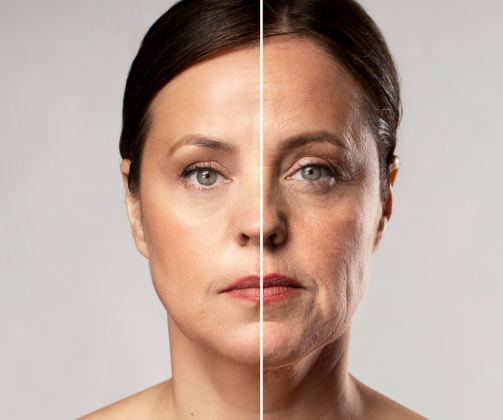 Wrinkle Reducing – Extra Area