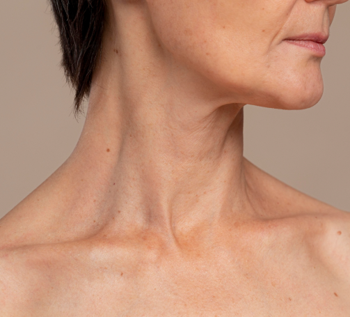 Nefertiti Neck Lift With Botox
