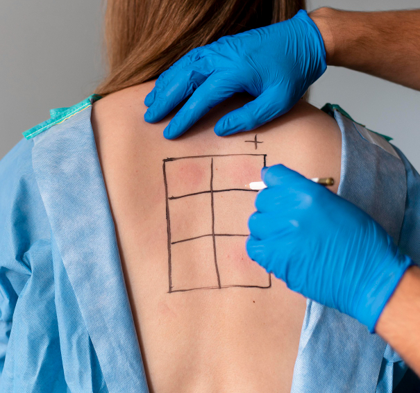 3D HIFU – Body - Consultation & Patch Test 