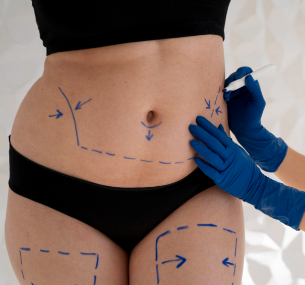 3D HIFU - Hips Superficial Fat Removal 