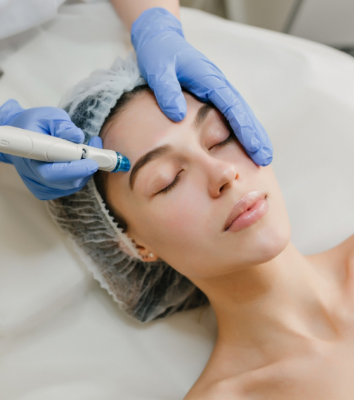 Dermapen - Exosomes Hair Loss Treatment 